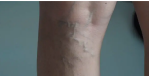Varicose vein removal no surgery 